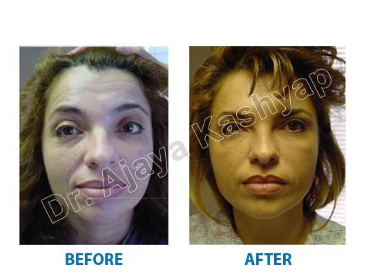 botox treatment for face