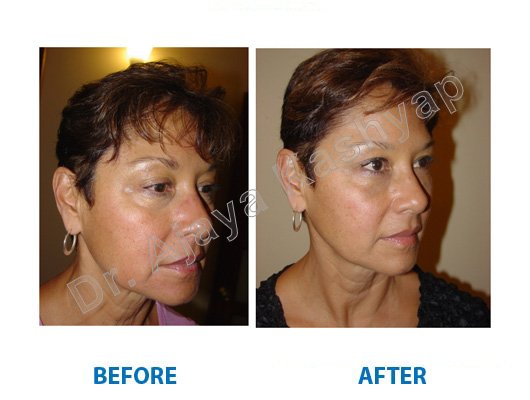 filler treatment for acne scars